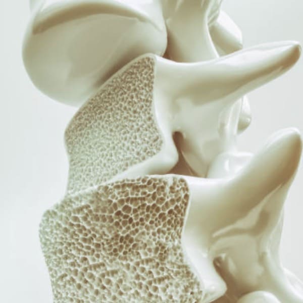 Osteoporosis Y Osteopenia