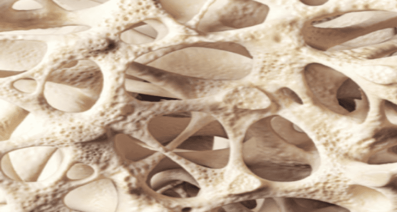 Osteoporosis Y Osteopenia