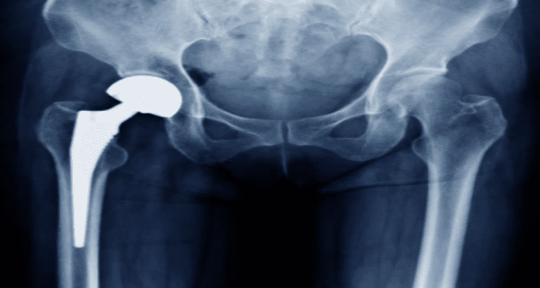 Reemplazo articular